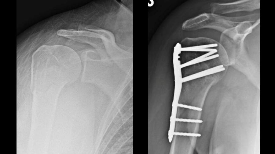 AOFoundation's tweet photo. 🚀#InnovationsFriday
A new clinical case showcases the VOLT™ Proximal Humerus Plating System.
A 24‑year‑old patient treated with a 3‑hole VOLT™ plate—designed for flexible placement and better screw positioning.
💡 Innovation in action: 👉 https://t.co/Xw4WzU4LWb https://t.co/z2vf4xeNQC