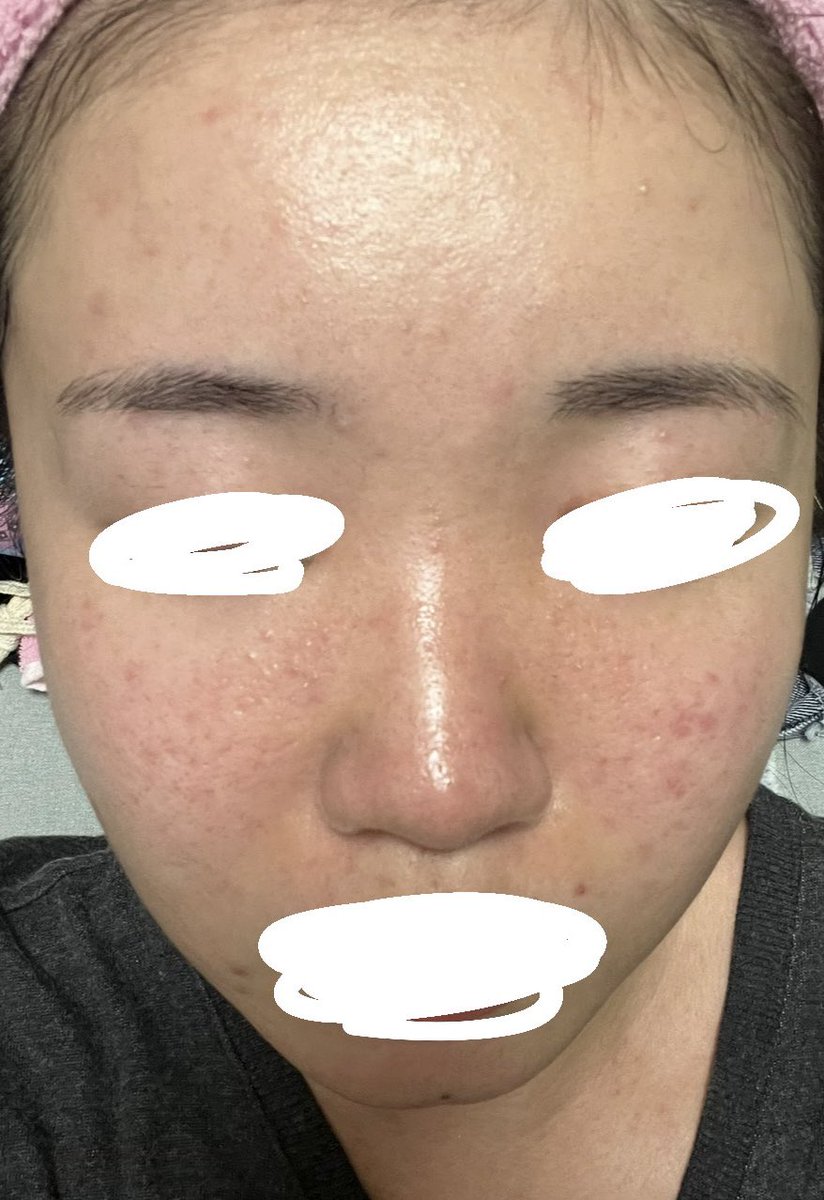 __runpon__'s tweet photo. イソトレチノイン約1年服用して本当に綺麗になって飲んで良かった！！
血液検査はもちろん定期的にやってて
肝臓の数値は少し上がったけど元々酒飲みで常に高いのもあったし、中止するほど数値が酷いわけでもなかった！

飲む前と飲んだ後！
これからは毛穴ニキビ跡治療に専念していく🥹 https://t.co/DYLsTbBj8p