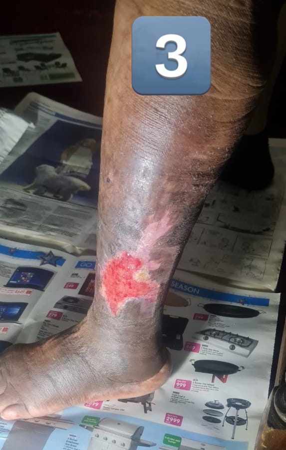 The family said something this amazing shouldn’t be kept private. (Over 80 years old, diabetes and hypertension but NATURE said hell no to amputation) 

3rd Frame is the latest results surely by end of April she will be 100% ok.. stay tuned! 👏🏾🍃💚