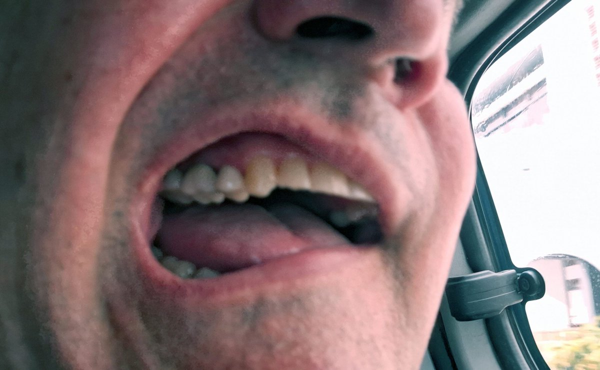 Emergency Dentist in the Dominican Republic: Leaving Norwegian Viva for Urgent Dental Care dlvr.it/TRSvXr