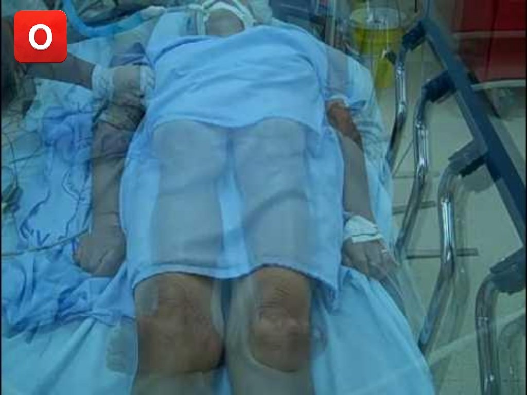 DoctorDatos's tweet photo. @IhabFathiSulima @mijito_ither 🅾️Stage 2 decerebrate posturing is an abnormal rigidity (hypertonia) characterized by rigid extension of arms and legs, internal rotation, and arched neck, indicating severe damage to the brainstem or midbrain.
#Doctors https://t.co/7qcE4BGuno