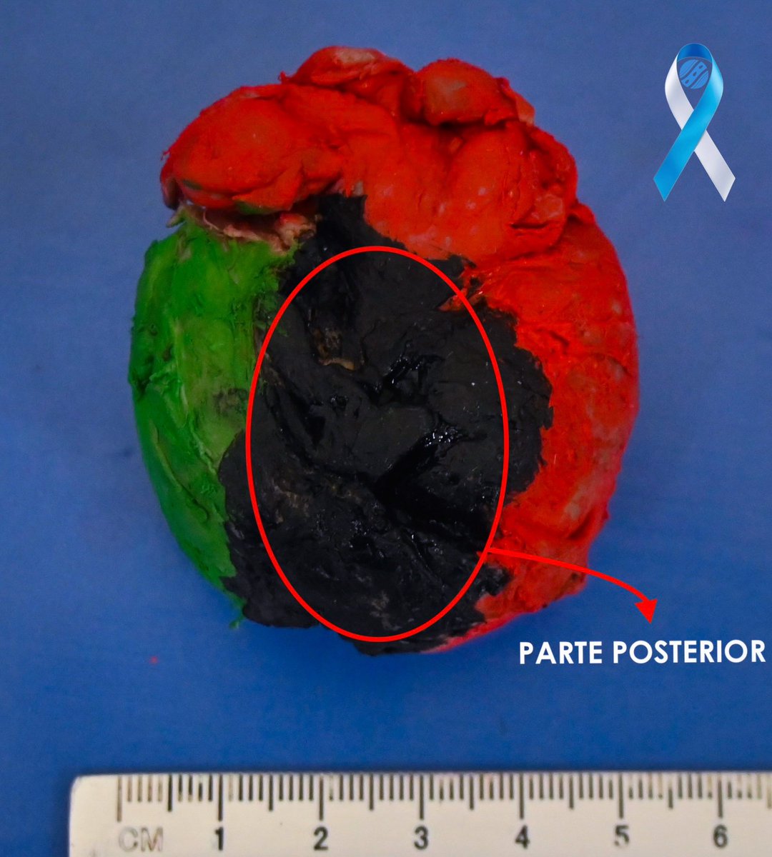 md_castaneda23's tweet photo. Prostatectomia radical
Carcinoma acinar
#cinditlab https://t.co/VATArTWDr3