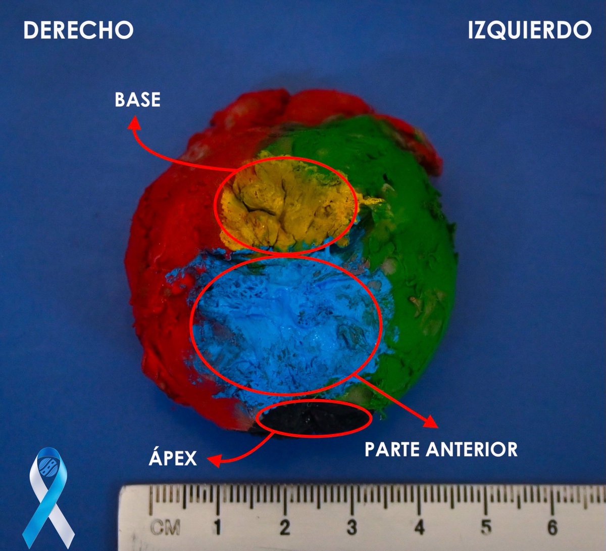 md_castaneda23's tweet photo. Prostatectomia radical
Carcinoma acinar
#cinditlab https://t.co/VATArTWDr3