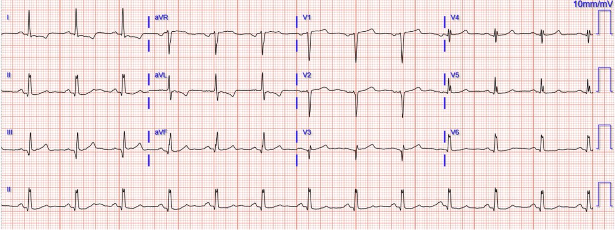 smithECGBlog's tweet photo. Quiz post: both patients with acute chest pain in the middle of the night, which or both or neither need emergent reperfusion?

Published study: When the ECG was very difficult, the Queen was 7.36 times more likely to be correct than the Standard of Care.

@PendellM @PMcardioApp 

https://t.co/9tgm6N4TLZ