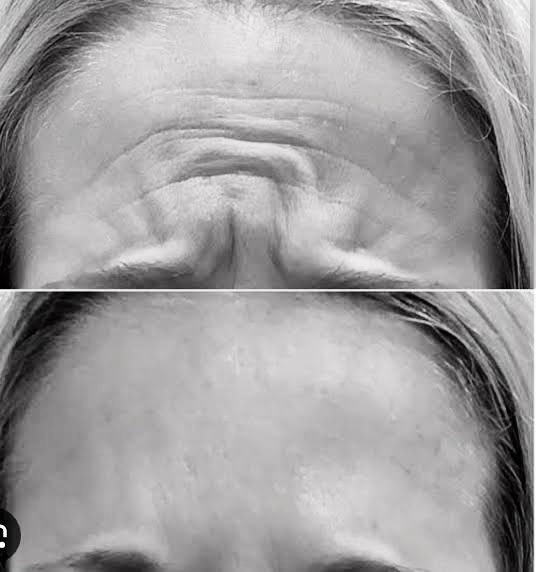 少しセンシティブな内容だが、気づきがあり、腑に落ちた。精神疾患は容姿、とくに目周辺に出るようだ。
加齢由来の落ち窪みだけではなく、精神疾患特有の顔貌や目の雰囲気になる臨床例がある。

写真は鬱のサンプル。
こんな皺がありませんか。