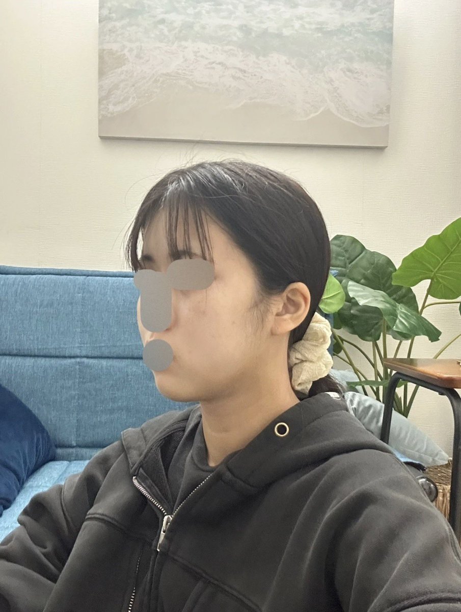nonpomrin's tweet photo. DU 美容外科 顎下脂肪吸引 14日後レポ https://t.co/D5fS26a0Xd