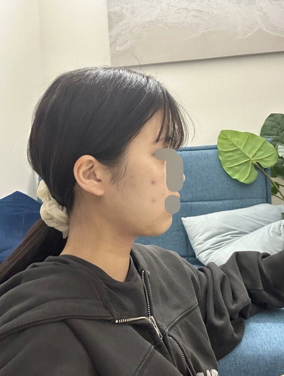 nonpomrin's tweet photo. DU 美容外科 顎下脂肪吸引 14日後レポ https://t.co/D5fS26a0Xd