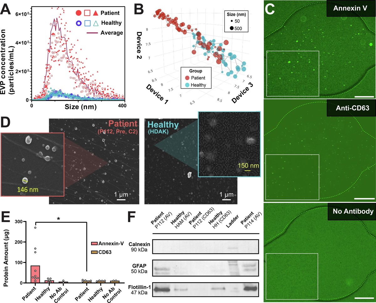 LurieCancer's tweet photo. A #NatureCommunications study shows that transient #BloodBrainBarrier (#BBB) opening triggers a rapid surge of tumor‑derived extracellular particles in the bloodstream, providing a minimally invasive biomarker for #glioblastoma susceptibility to #paclitaxel. This real‑time signal could help personalize therapy after a single treatment. https://t.co/znO6s5m6ha
