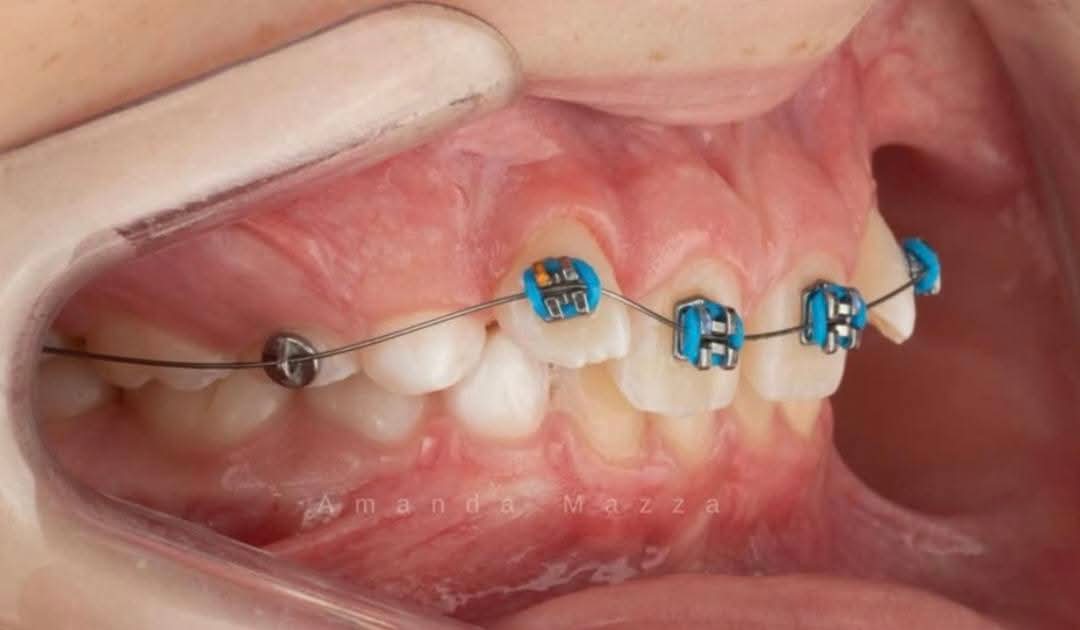 TravisKstro's tweet photo. ☝🏼4X2 ... una parte importante de la Ortodoncia Interceptiva que nos permite dar resolución a problemas transversales en pacientes pediátricos/crecimiento 🦷🔧🪥 @OviDentalGo @ODONTOSALUD https://t.co/RTaUvL1Amy