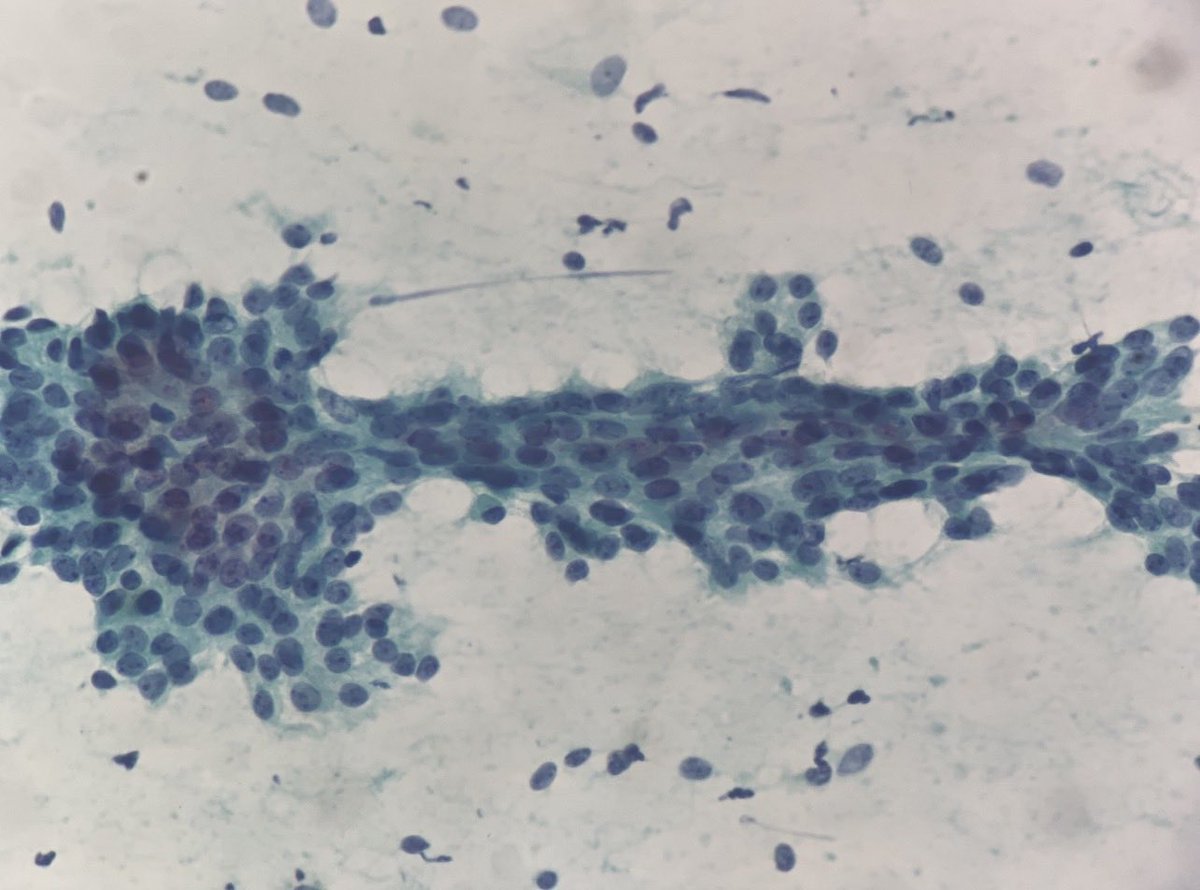 vi_monappa's tweet photo. #fnac #breastpath #pathresidents  #pathx #pathclassic 
30/F breast lump https://t.co/GERyTDS49A