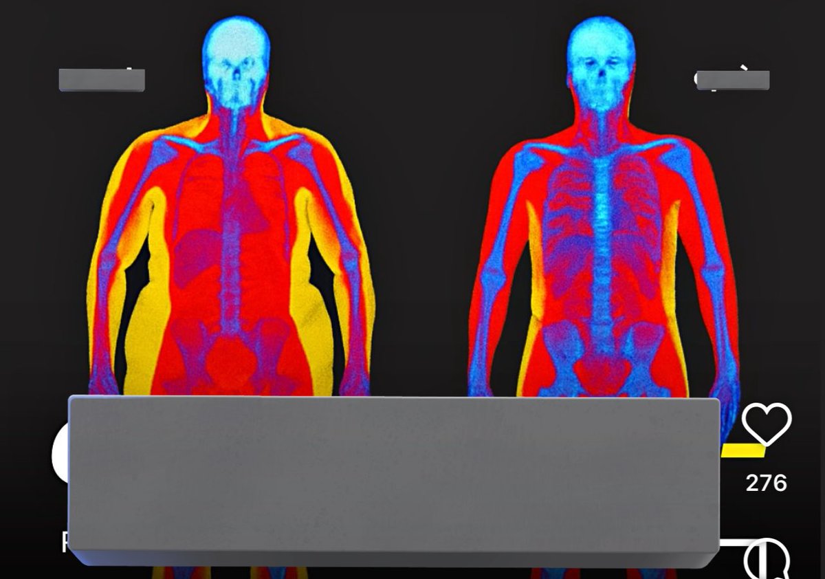 I NEVER RLLY KNEW WHAT A DEXA SCAN WAS UNTIL I SAW THIS AD
I HAVE TO TAKE ONE FOR OSTEOPENIA ITS GONNA BE SO TRIGGERING IM SO NOT READY