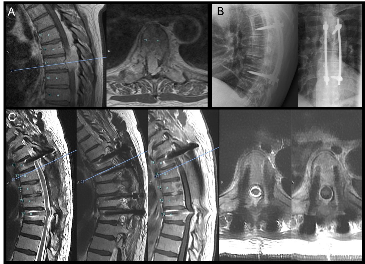LubelskiLab's tweet photo. Carbon fiber–reinforced PEEK (CFR-PEEK) screws offer superior radiolucency on imaging, facilitating improved tumor surveillance and radiation planning. Although CFR-PEEK instrumentation provides distinct advantages in spinal oncology, its widespread adoption remains limited by cost. Hybrid titanium/CFR-PEEK constructs have therefore emerged as a pragmatic alternative. 

Our cost-effectiveness analysis demonstrates that hybrid constructs provide a more economically favorable option compared with all–CFR-PEEK constructs, supporting their role as a financially sustainable strategy in oncologic spine surgery.

@HopkinsNsurg @HopkinsSpine @HopkinsMedicine 
@CarboFix @icotecmed 
#Neurosurgery