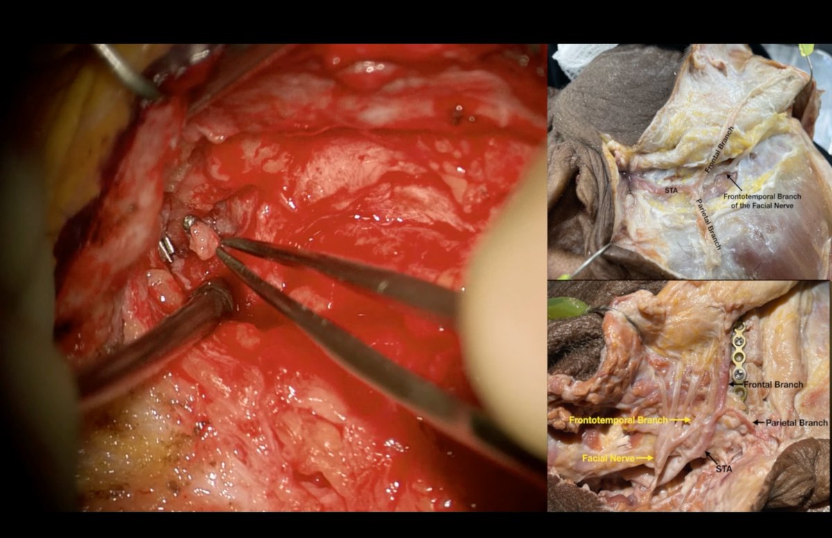 drufukerginoglu's tweet photo. New in Operative Neurosurgery: 🧠Microsurgical reconstruction of the frontotemporal branch of the facial nerve using a sural nerve graft after iatrogenic injury during STA biopsy performed at an outside facility.
🔗 https://t.co/3i4KcqzFAe
#Neurosurgery #Microsurgery #UWHealth https://t.co/k0nbEQTnmg