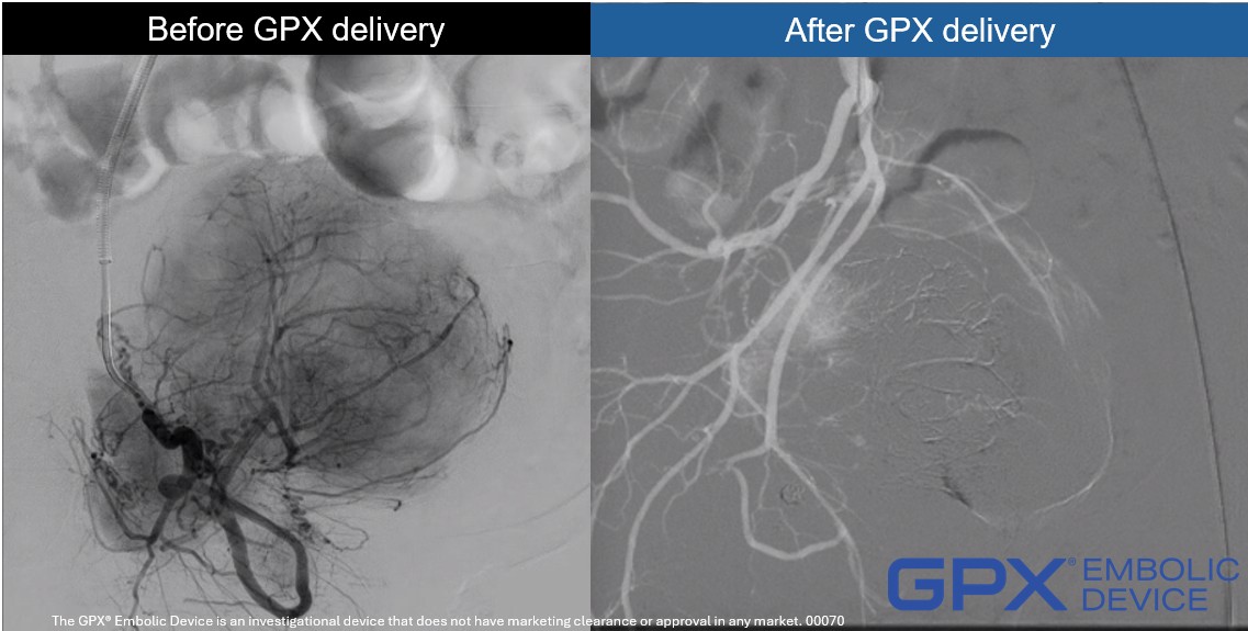 GPX_Embolics's tweet photo. Tumors may look complicated, but #embolic devices should not be. The #GPXEmbolic demonstrated consistent, fast, and complete occlusion of #tumors in a feasibility trial (JVIR). We are looking forward to sharing the results from the pivotal IDE trial at #SIR2026. #IR #oncology #NV https://t.co/1JHm9euo2n