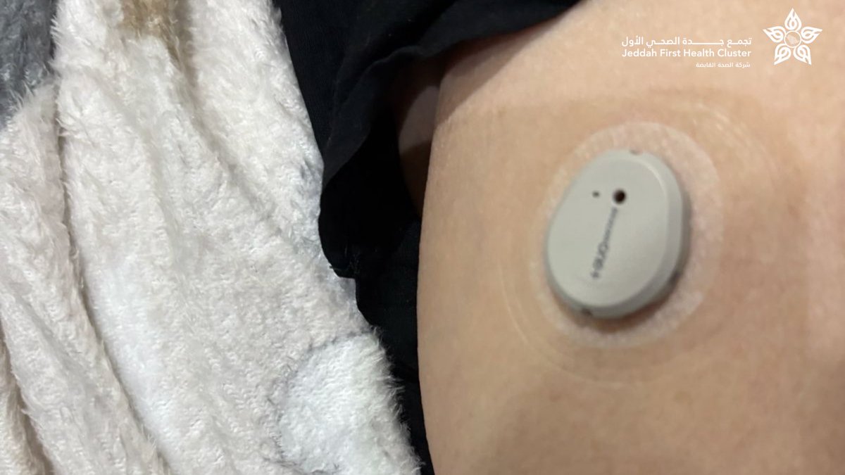 في إطار التكامل بين الخدمات الصحية وتطوير الخدمات المقدمة للمستفيدين  أطلقت إدارة الرعاية الصحية المنزلية بالتعاون مع مركز السكري بـ #مستشفى_الملك_عبدالعزيز_بجدة مشروع قياس السكر باستخدام جهاز القراءة المستمرة دون وخز (Continuous Glucose Monitoring)، لتمكين مرضى السكري من متابعة