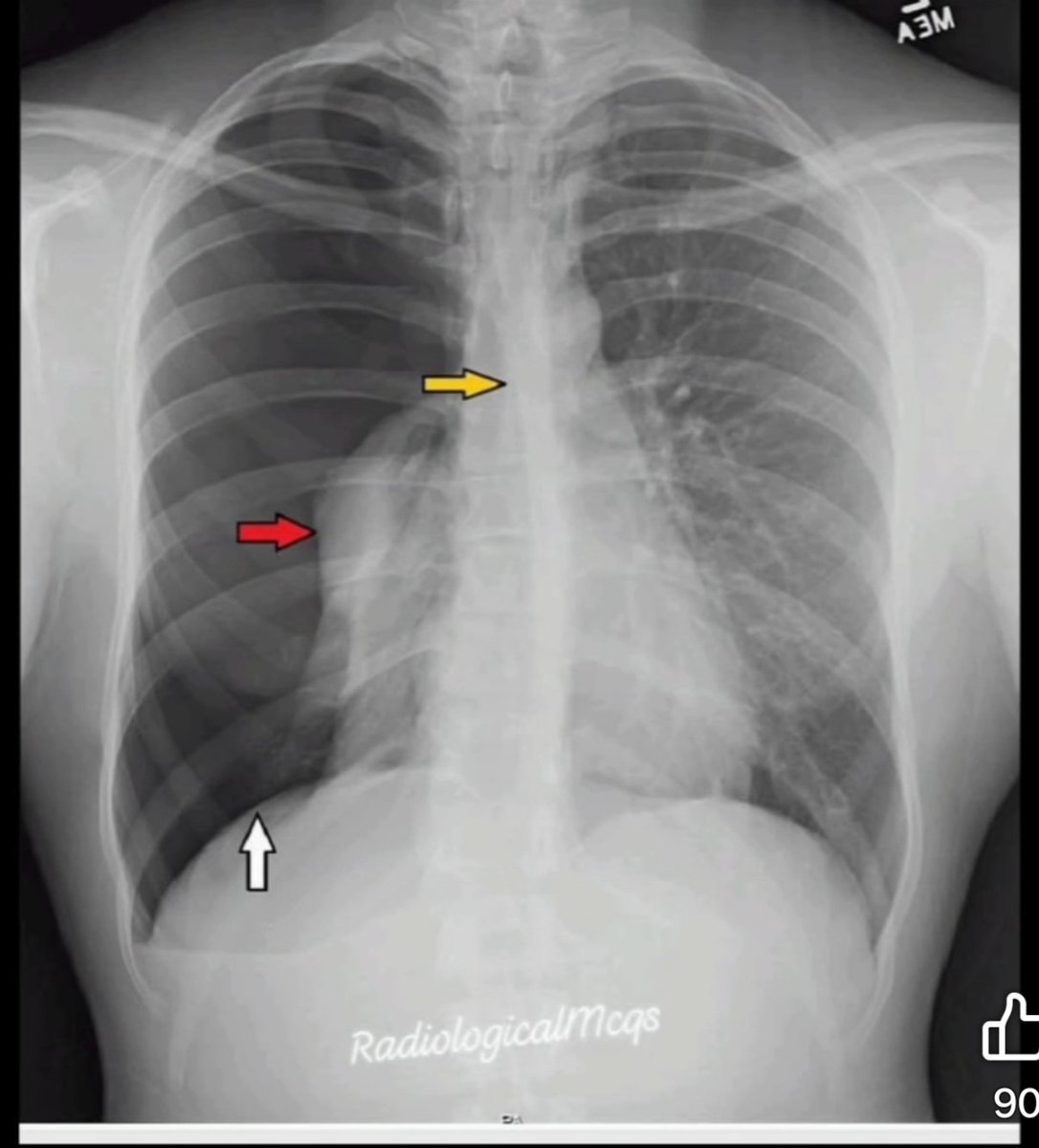 albertoortegana's tweet image. 26-year-old male presents with right-sided chest pain and shortness of breath after blunt chest trauma during BJJ practice. A chest X-ray is shown. What are the findings and diagnosis #radiology #wellness #xray #tuberculosis #health #pulmonology
@dr_manish_ydv @Dr_Shiv_kumar_