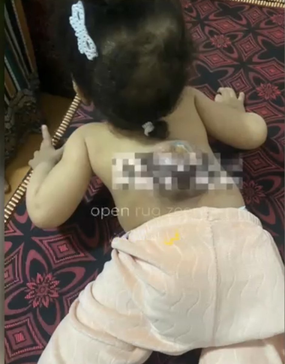 There’s this 3-year old girl that desperately needs your help. She’s born with the most fatale version of open back and sadly the resources in morocco can’t get her the surgery she needs.

🚨 Donate for the surgery of 3 year old Alaeh:

gofund.me/ae17179c6