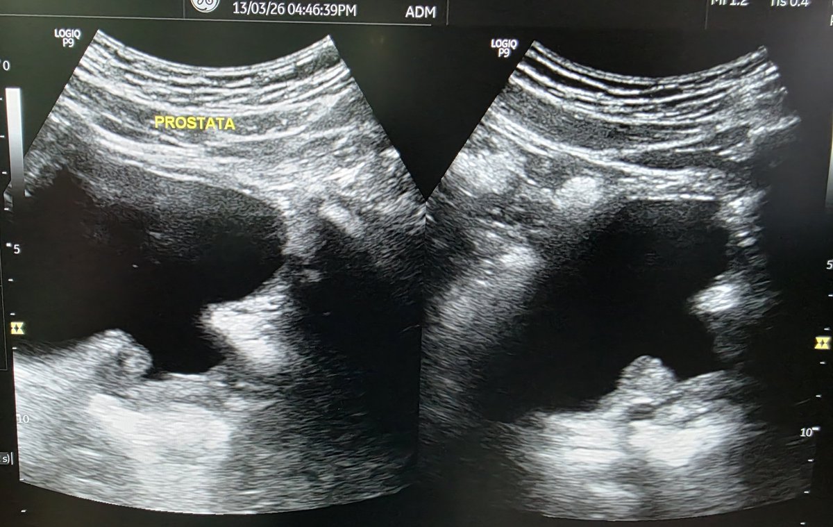 urotelio's tweet photo. #HoLEP? Nope, this is my patient 5 years post-surgery #BipolEP
@RomanCarvajal @lfredosanchez #UroSoMe https://t.co/FIamslbbW6