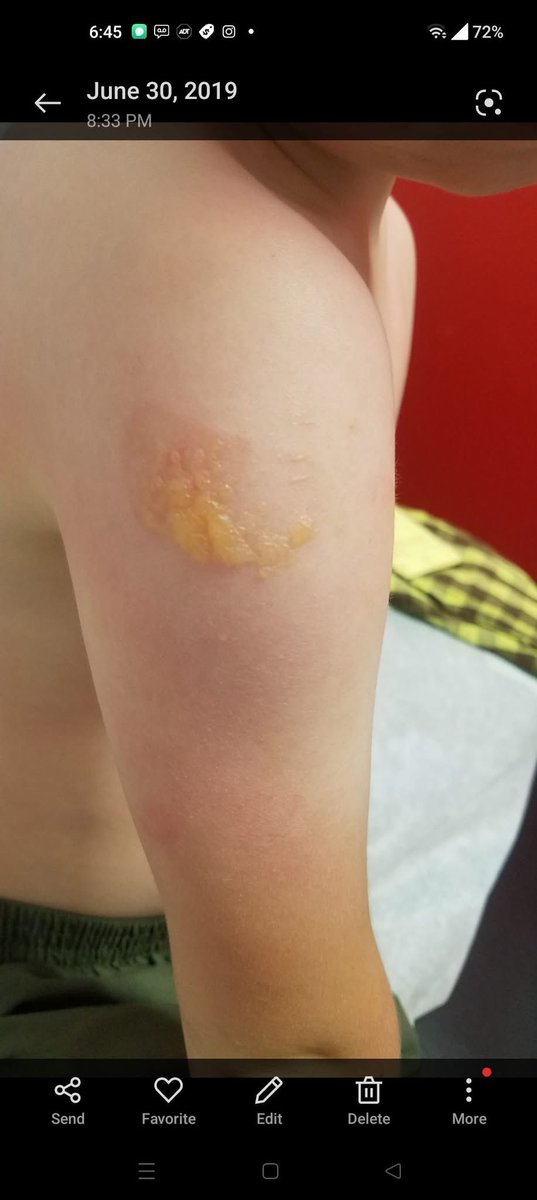 toobaffled's tweet photo. Words cannot even explain how appalled and upset I am. My son had all his DTaP vaccines as a child, and every time he got them, the reaction got worse and worse. He had 104.5 fevers and cried non-stop for days. His fourth one was particularly bad, and I was assured it was “normal.” I was naive back then and trusted the doctors completely.

He got his fifth one in 2019, and again… fever and crying for days, followed by breaking out in blisters a week later, so large and yellow they had to be bandaged. Once more, I was told it wasn’t the vaccine, even though it happened right in the same spot where they injected it.

Fast forward to 2026, and he needs a Tdap for seventh grade. I went to his paediatrician, the same one he’s seen since birth, and asked for an exemption for this one vaccine. The doctor agreed that the next reaction would most likely be worse and that he shouldn’t even attempt to get it until at least 10 years have passed. He confirmed it’s in the CDC guidelines as a precaution that certainly qualifies as grounds for an exemption, and that the benefit does not outweigh the risk in his case.

Now here’s the kicker… Being in California with our strict vaccine laws, and doctors not being able to issue more than five exemptions a year without scrutiny, he told me he’s not going to issue one and doesn’t do them for anyone. But he still agrees it’s dangerous to give it!

I know this man well, he’s taken care of all three of my children for 12 years. He proceeded to tell me that after 45 years practicing pediatric medicine, he’s going to be stepping out because California is forcing him to go against his oath of “do no harm” and not allowing him to make medical decisions for his patients. He was ready to cry as he apologized to me and said I need to take my son to see an allergist to try to get an exemption, even though, as my son’s doctor, he advises not to give the Tdap vaccine because a worse reaction is most likely!

How is this not criminal? I don’t even know how to feel, and I feel for this man and the impossible position that Gavin Newsom has put him in. Something needs to be done about this because not all parents are able to homeschool, and homeschool isn’t the best choice for all students!