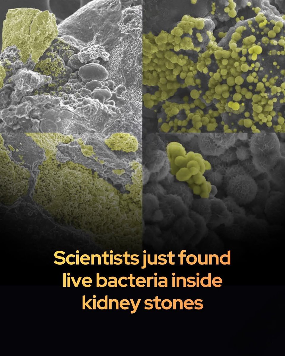 Scientists find living bacteria is literally inside kidney stones…

Breakthrough research identifies hidden bacteria inside calcium kidney stones, potentially rewriting the medical understanding of how these painful crystals form.

For decades, the medical community viewed