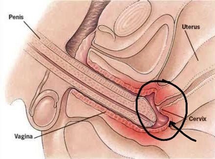 YOU SHOULD NEVER IGNORE BLEEDING AFTER EVERY SEXUAL INTERCOURSE.

DEAR MEN, IF SHE SAYS SHE WANTS TO BE CHECKED,  SUPPORT HER. 

WOMEN, BE FAITHFUL TO ONE MAN, SOME MEN CARRY HPV AND ARE UNAWARE

Walk with me. READ. SHARE. REPOST 

Dear Women,

When Sex Ends With Blood: What