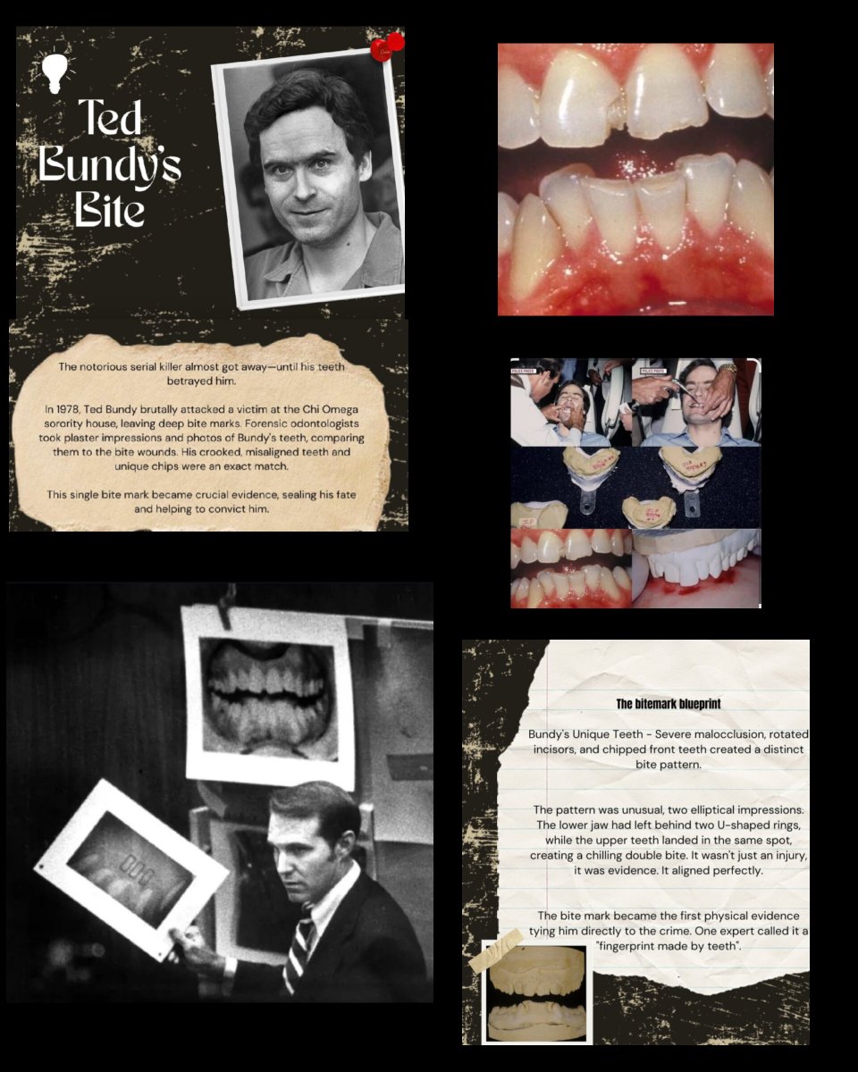 SdcForensic's tweet photo. The first resolved case using Bitemarks, time when Forensic Odontology took a turn!! #tedbundy #serialkiller #bitemarks @SIMATS_Univ @simatsofficial https://t.co/Mg3Xp1nZEt