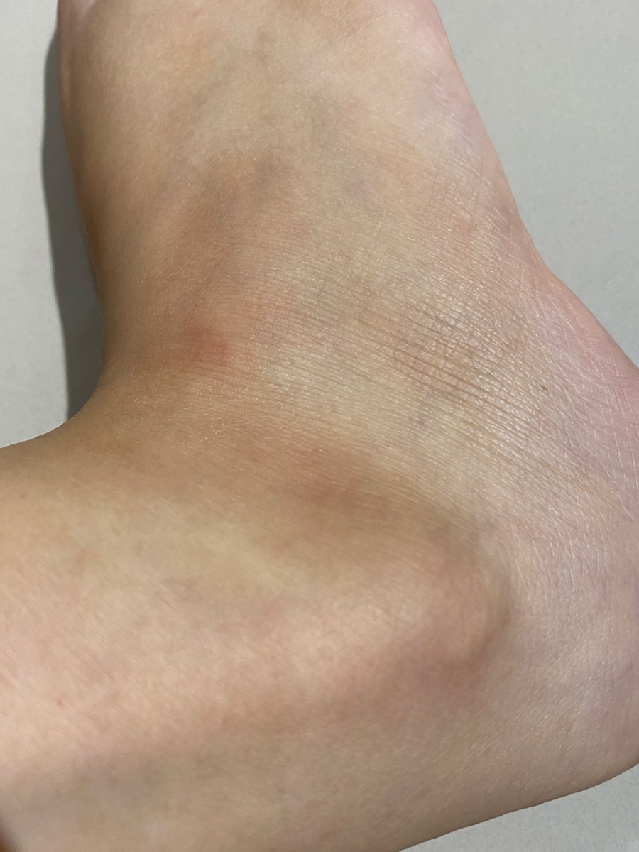 blissfulfancy's tweet photo. keinget waktu KKN tiap hari duduk sila di rumah warga sampe mata kaki menggelap, kering &amp; kulitnya ngelupas sampe perih…

tapi percaya ga itu sembuh ga ada 2 minggu… kuncinya = EXFO😭💯✨

before                                                 after https://t.co/4Zw5VM5Emj