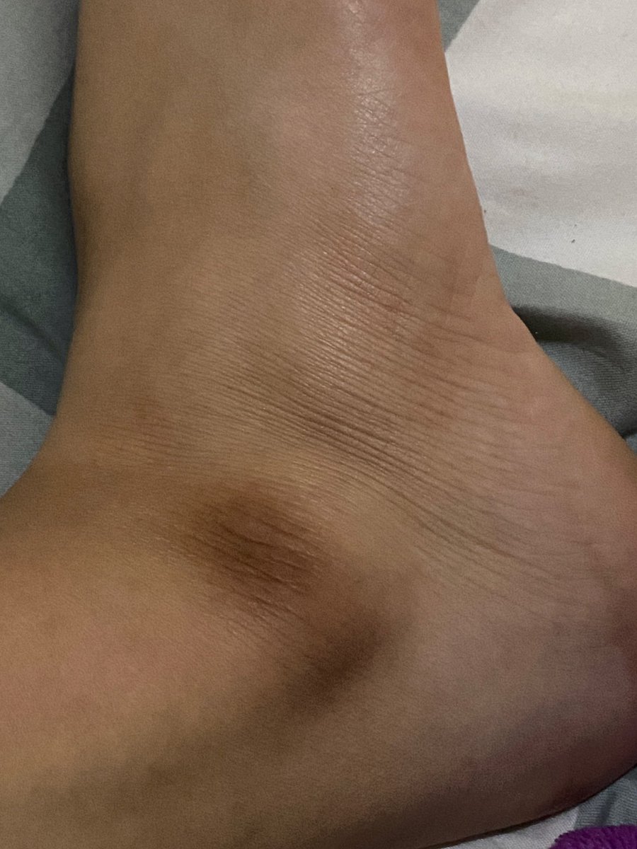 blissfulfancy's tweet photo. keinget waktu KKN tiap hari duduk sila di rumah warga sampe mata kaki menggelap, kering &amp; kulitnya ngelupas sampe perih…

tapi percaya ga itu sembuh ga ada 2 minggu… kuncinya = EXFO😭💯✨

before                                                 after https://t.co/4Zw5VM5Emj