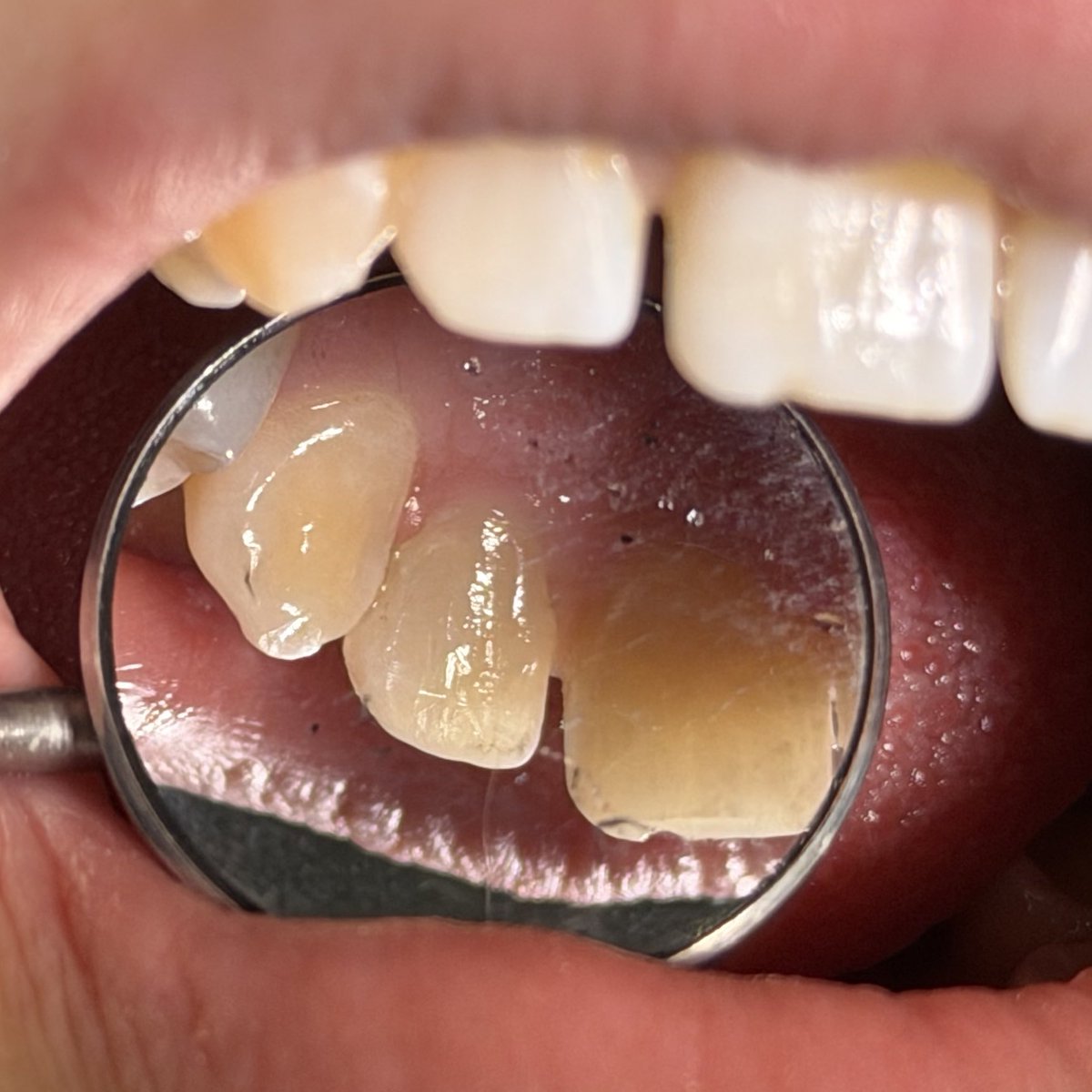 sdentist4's tweet photo. Class III https://t.co/YzAJfgHelO