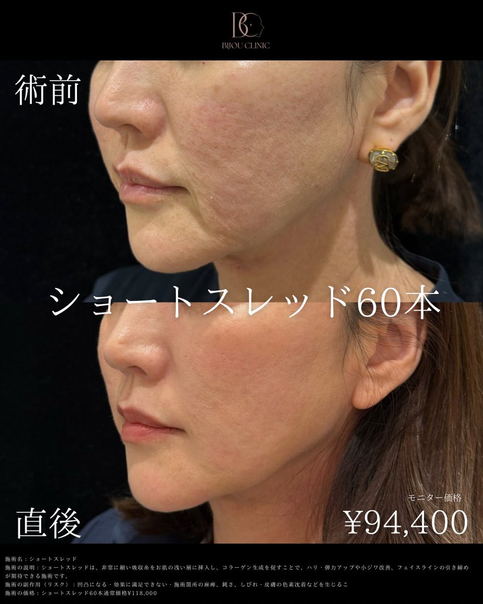 bijoclinic's tweet photo. 口横のポニョやほうれい線にはショートスレッドがおすすめです🪡全顔モニター様60本¥94,400です✨定価でも11万円なので渡韓するよりお得です🫧 https://t.co/QeZ149lOQR