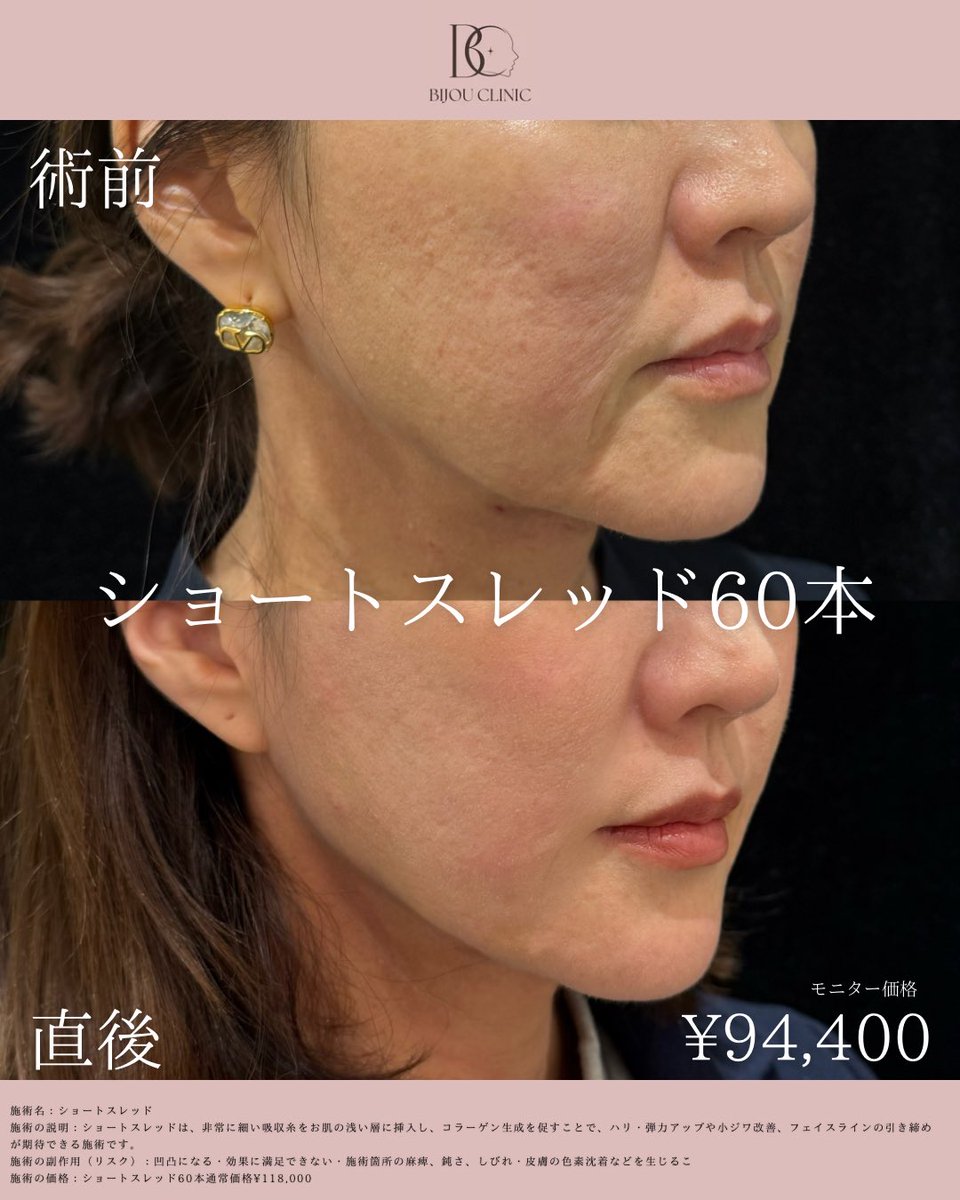 bijoclinic's tweet photo. 口横のポニョやほうれい線にはショートスレッドがおすすめです🪡全顔モニター様60本¥94,400です✨定価でも11万円なので渡韓するよりお得です🫧 https://t.co/QeZ149lOQR