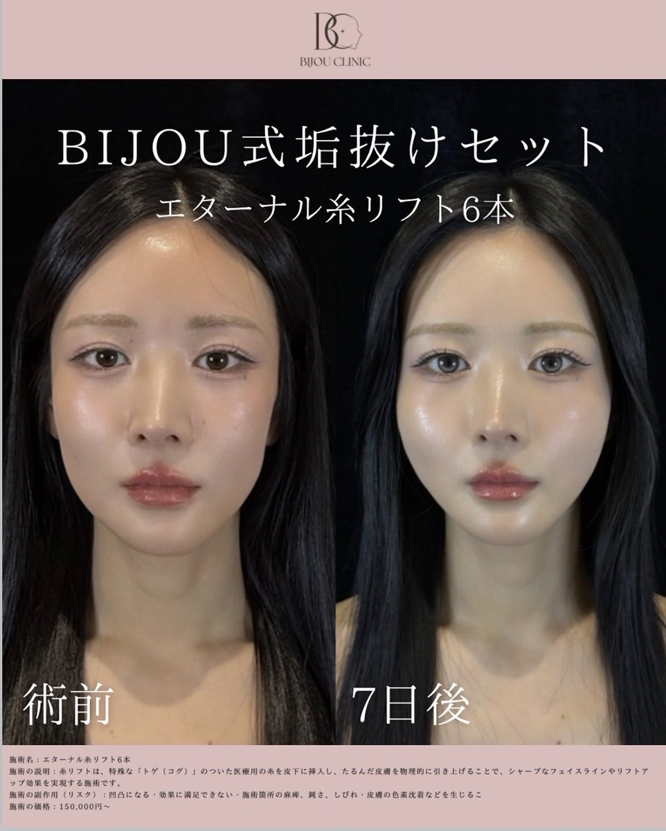 bijoclinic's tweet photo. 元からお顔が小さい方も当院の糸リフトは6本だけでもかなり変わります🎀当院は広告費を1円もかけてないため、銀座でこの価格🫶🏻渡韓する必要ないです🙂‍↕️🤍 https://t.co/vK6v9RXjAM