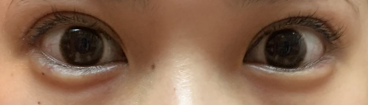 fu25n_'s tweet photo. 二重全切開 経過（DT約1ヶ月）

1ヶ月検診でついでに涙袋にヒアルいれた🤍
まだ腫れてて不自然だったのが、ヒアルを入れたことで上瞼と下瞼の派手感が少し釣り合って前より自然に見える気がする！ 
#二重全切開 https://t.co/XeNQMLWSz9