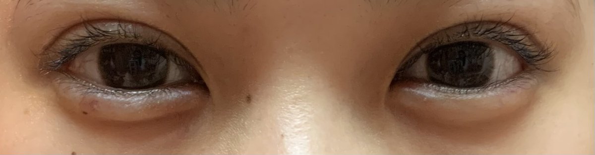 fu25n_'s tweet photo. 二重全切開 経過（DT約1ヶ月）

1ヶ月検診でついでに涙袋にヒアルいれた🤍
まだ腫れてて不自然だったのが、ヒアルを入れたことで上瞼と下瞼の派手感が少し釣り合って前より自然に見える気がする！ 
#二重全切開 https://t.co/XeNQMLWSz9