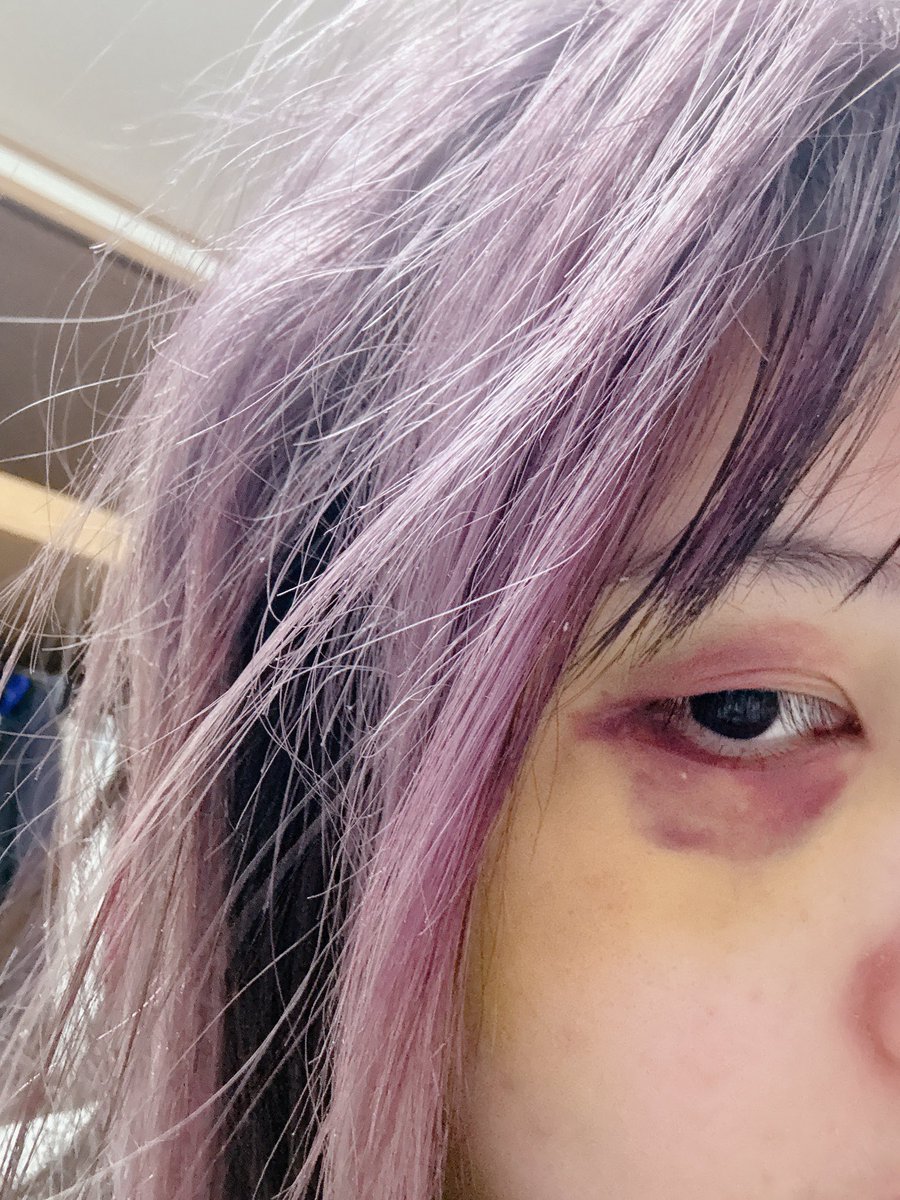 救急車に運ばれたのと、帰宅後階段を登ってる最中に意識を失い左目を強打したようです。
頭の中の情報がぐちゃぐちゃになって時系列などがわからない状況のためご連絡にもお時間がかかります…
最初よりは良くなった方なので左目の写真をセンシティブにてあげさせていただきます。