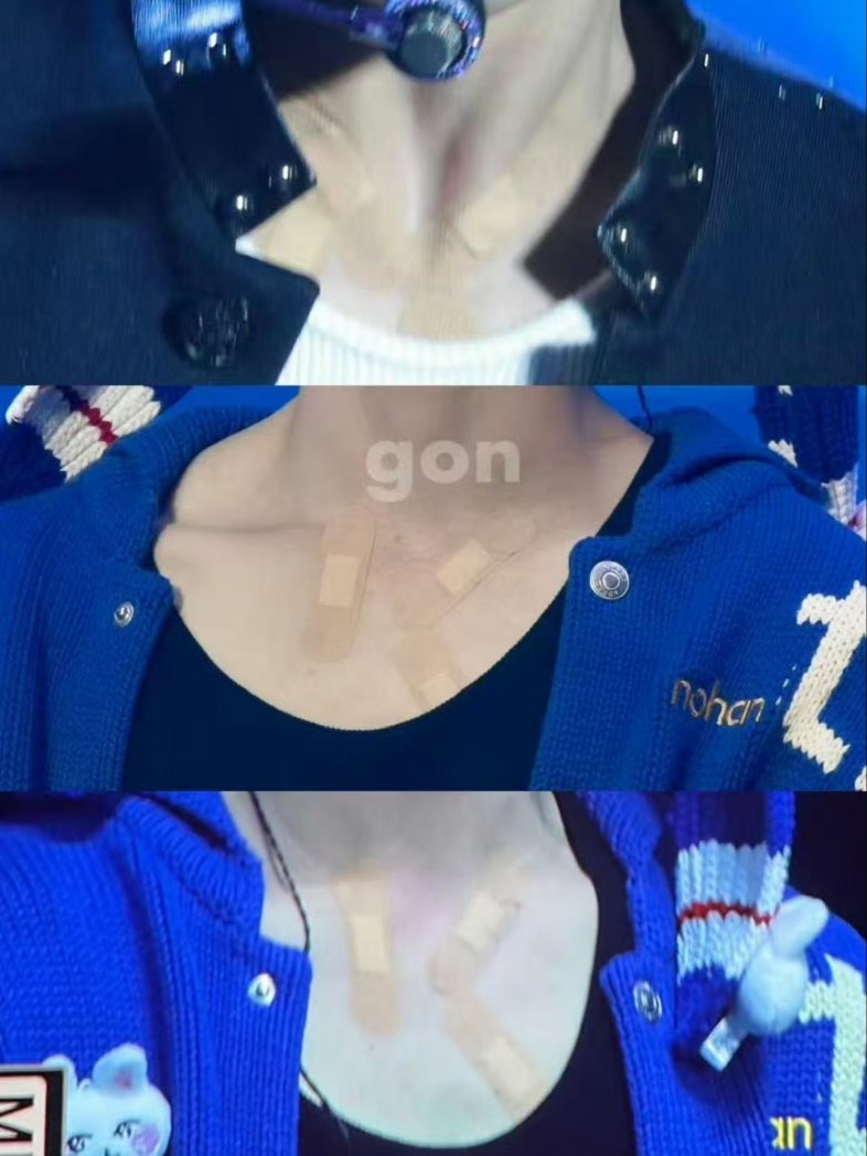 yupeaches's tweet image. yujin’s band-aid fell off and the skin's completely clean but the upper area still shows a noticeable patch of red wheals seems like yujin had hives :( when contact with heat or sweat turns red and itchy but it disappears within half an hour. yujinie stay strong and healthy❤‍🩹