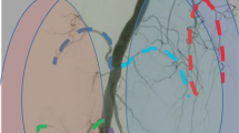 cvirendo's tweet photo. This article explores periarticular cooling reduces non-target perfusion in genicular artery embolization: a quantitative angiographic study

https://t.co/rZb1tkH4rK

#IRad #interventionalradiology https://t.co/76kJUsXWOU