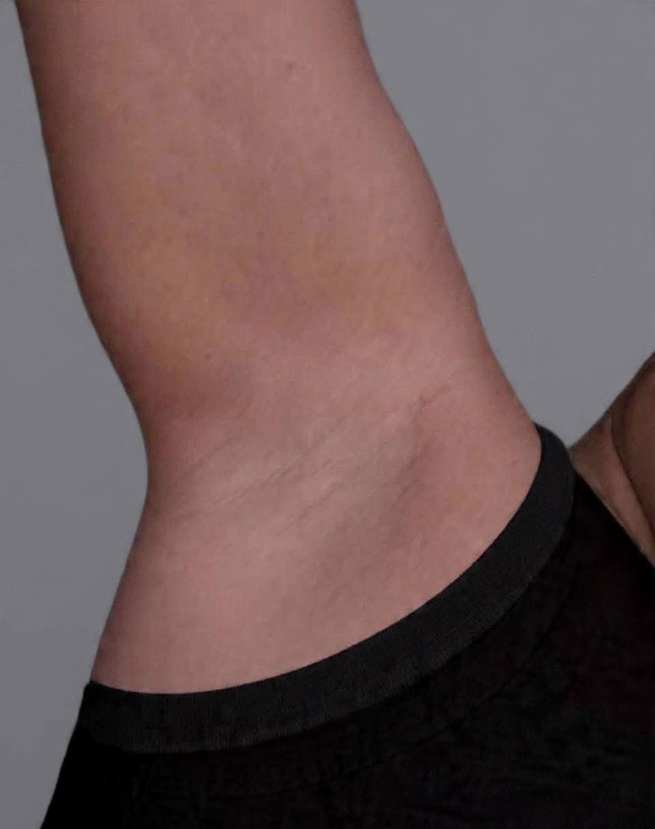 If you apply this after bath before bed consistently, you could get clear underarms. 👍🏽