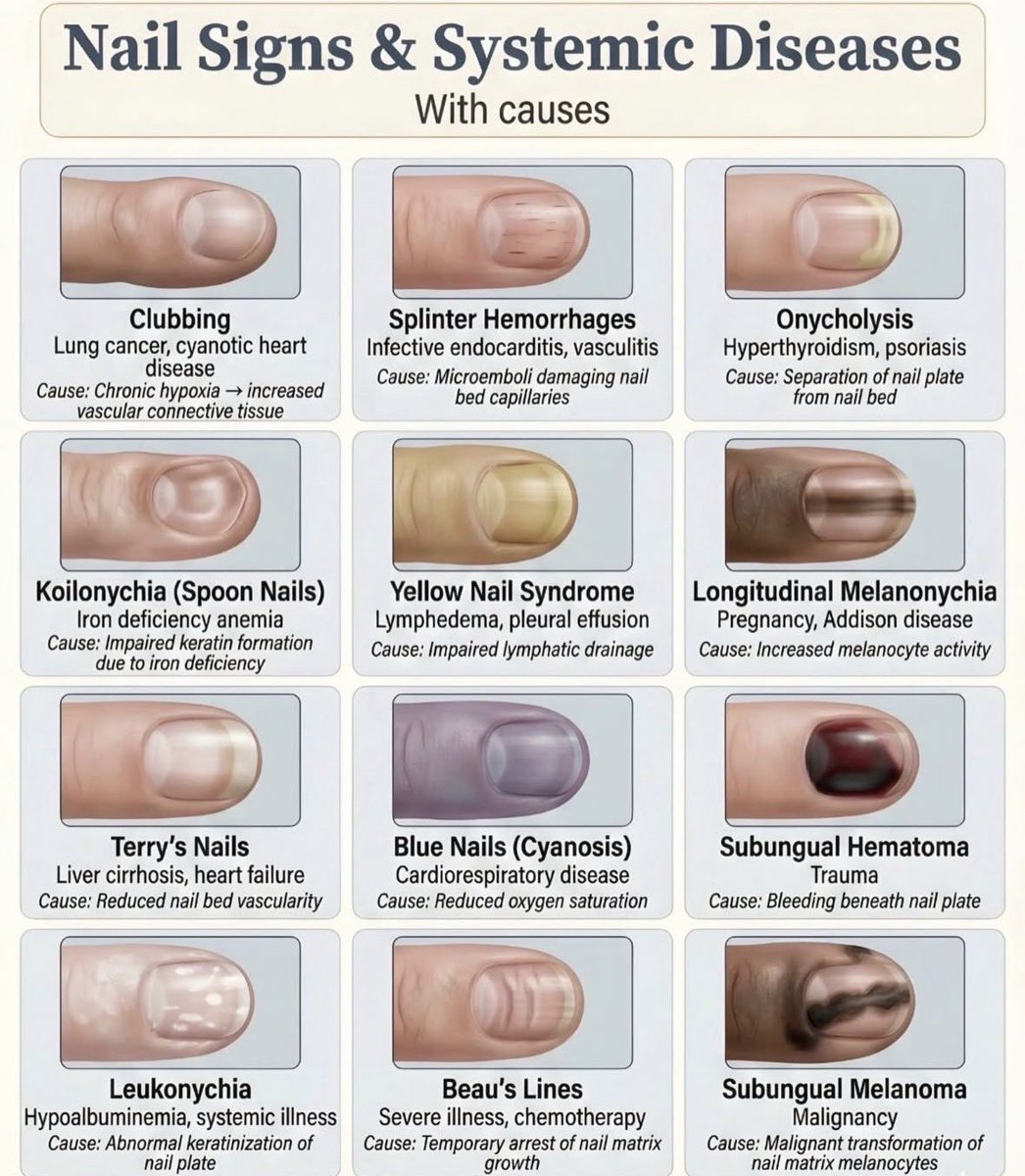 Doctors__squad's tweet photo. Nail Signs &amp; Systemic Diseases… https://t.co/PRaGnwXv9Y