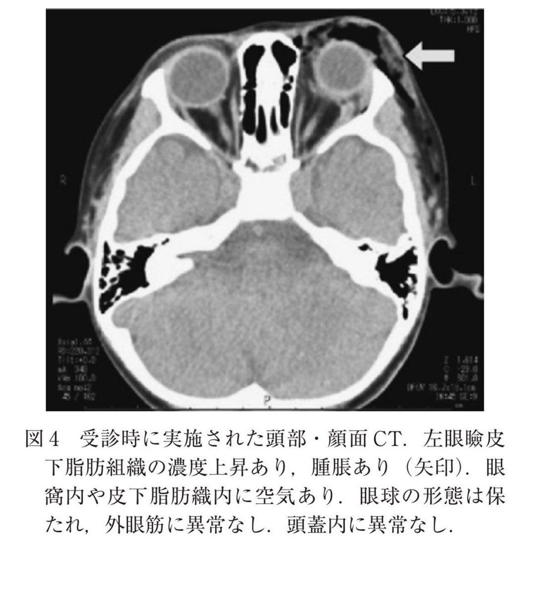 Shiba_kids's tweet photo. #InjuryAlert【金属製のフックによる眼瞼裂創】
5歳児。保育園のテラスにいた。
タオル掛け下部の金属バーに足を乗せて揺らして遊んでいたところ、バランスを崩して転倒した。
物音を聞いた保育士が、患児の左眼裂から上眼瞼にフックが貫通した状態で倒れているのを発見し、医療機関へ救急搬送された。 https://t.co/NzAtWlQVUj