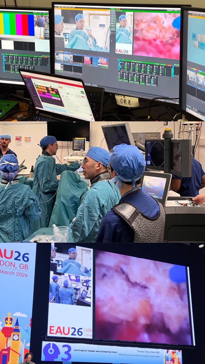 quanta_system's tweet photo. #RIRS with #CyberHoMagneto🧲 and Suction Access Sheath
Live from #EAU26: Dr. Thomas Tailly is performing this #livesurgery on the #Quantastage
#EmpoweringYourLaserChoice 🚀
#UrologyInnovation #MakeYourLaserChoice #QuantaSystem #BeQuanta https://t.co/qYzpFyX0z1