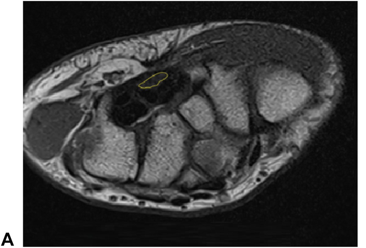 J Hand Surg Am- ASSH tweet media