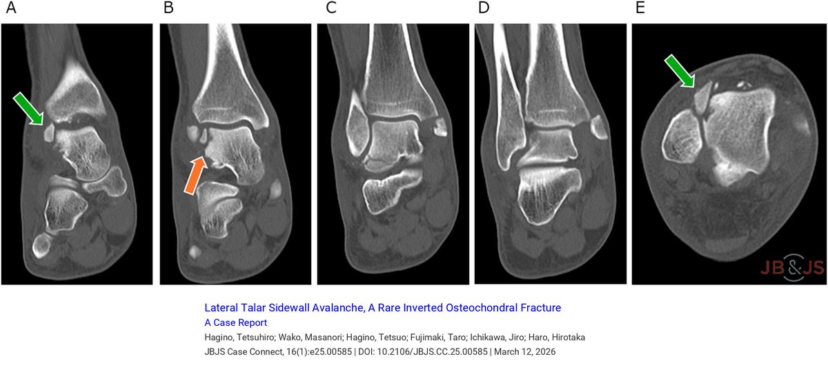 jbjs's tweet image. "Lateral Talar Sidewall Avalanche, A Rare Inverted Osteochondral Fracture: A Case Report" by Hagino et al.

Read the full article 👉 bit.ly/4uj1ZSm

#footandankle #trauma