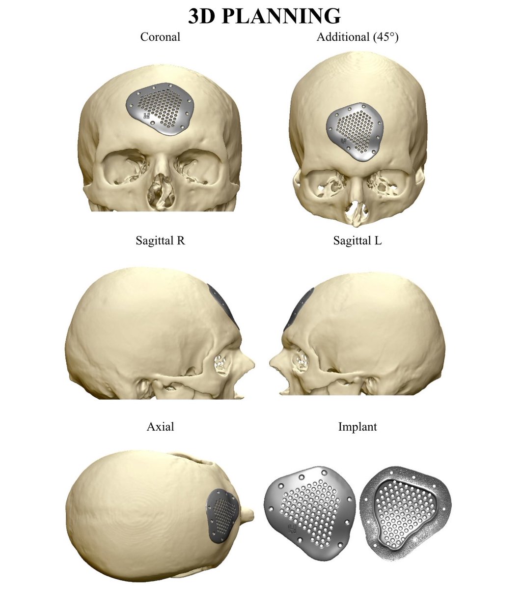 Dr_BagratB's tweet image. #Cranioplasty with a #patient-#specific #implant made of #Titanium the fusion of #surgery and #bioengineering. Based on #CT, implant is designed to precisely restore the patient’s #anatomy. It reestablishes brain protection, the #natural skull contour, and a sense of wholeness.