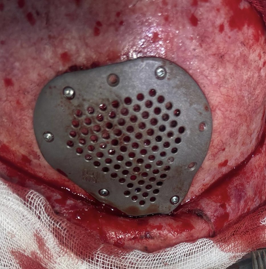 Dr_BagratB's tweet image. #Cranioplasty with a #patient-#specific #implant made of #Titanium the fusion of #surgery and #bioengineering. Based on #CT, implant is designed to precisely restore the patient’s #anatomy. It reestablishes brain protection, the #natural skull contour, and a sense of wholeness.