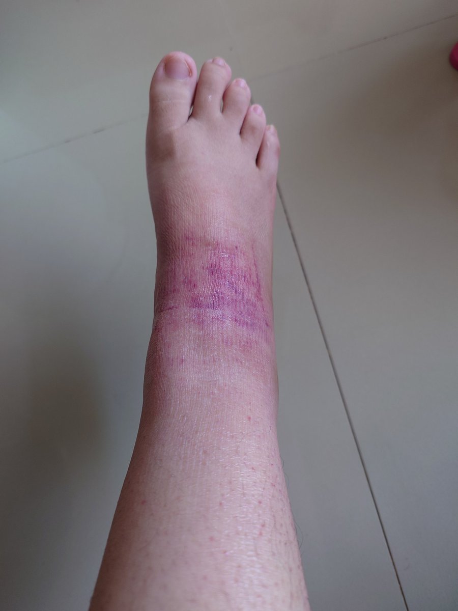 _stellakee's tweet photo. This sh!t hurts man. Past few mnths feel like a fever dream. I rly appreciate the lil things in life, such as being able to walk now 🥹 https://t.co/ib0fEBrQr2