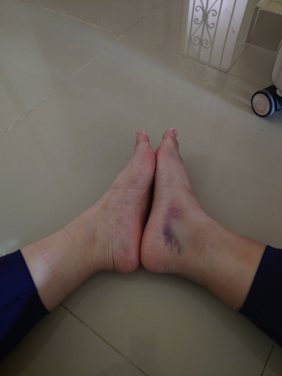 _stellakee's tweet photo. This sh!t hurts man. Past few mnths feel like a fever dream. I rly appreciate the lil things in life, such as being able to walk now 🥹 https://t.co/ib0fEBrQr2