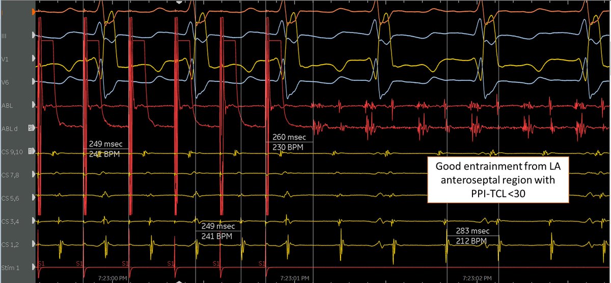 Teebi_MD's tweet image. 🧵Friday case pearl: Atypical #Flutter mapping is all about good entrainment. Single lesion = flutter terminated. 

✅RA map showed full CL of flutter
✅Entraining CTI, lateral RA, prox/dis CS= OUT
✅Entraining PW, MVA = OUT

👉LA Anteroseptal region with PPI-TCL &amp;lt;30 + complex