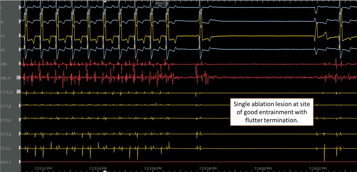 Teebi_MD's tweet image. 🧵Friday case pearl: Atypical #Flutter mapping is all about good entrainment. Single lesion = flutter terminated. 

✅RA map showed full CL of flutter
✅Entraining CTI, lateral RA, prox/dis CS= OUT
✅Entraining PW, MVA = OUT

👉LA Anteroseptal region with PPI-TCL &amp;lt;30 + complex