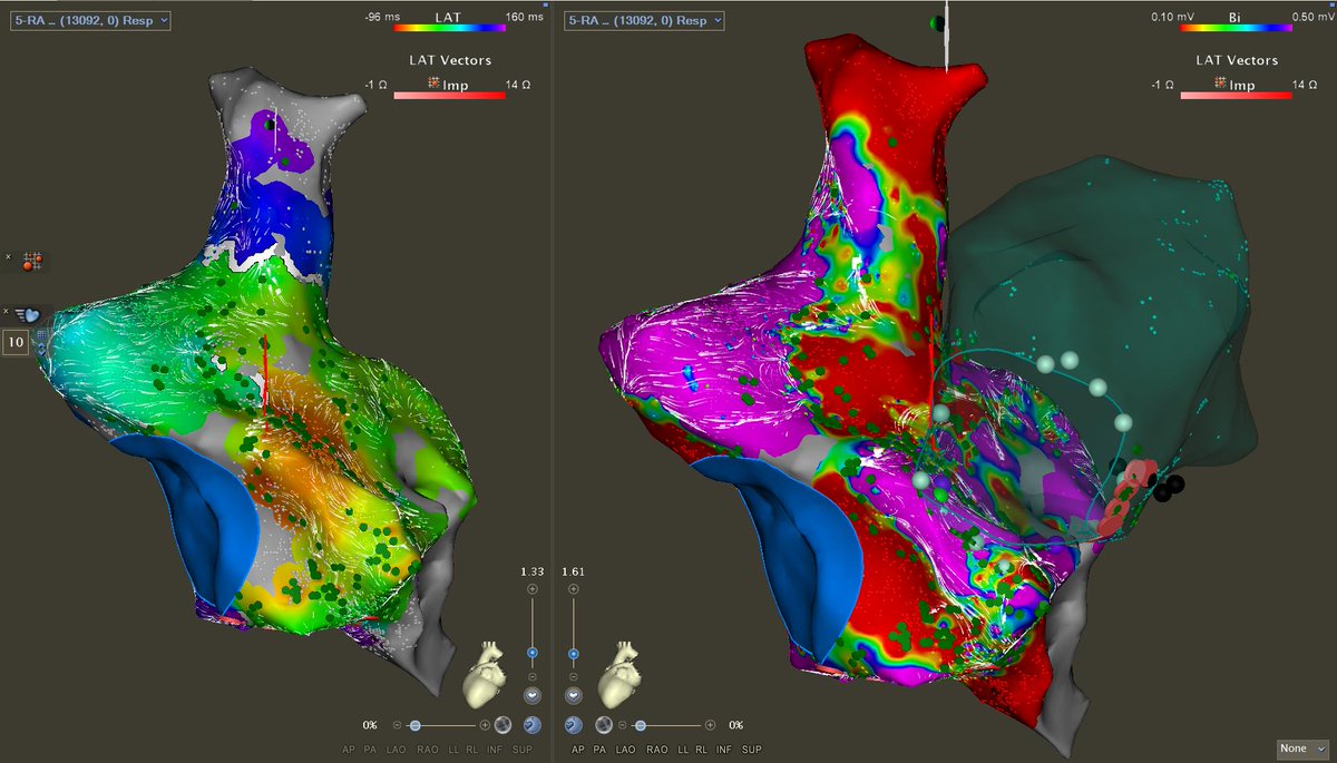 Teebi_MD's tweet image. 🧵Friday case pearl: Atypical #Flutter mapping is all about good entrainment. Single lesion = flutter terminated. 

✅RA map showed full CL of flutter
✅Entraining CTI, lateral RA, prox/dis CS= OUT
✅Entraining PW, MVA = OUT

👉LA Anteroseptal region with PPI-TCL &amp;lt;30 + complex